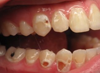 ZOBACZ CO SIĘ DZIEJE Z TWOIM CIAŁEM KIEDY PIJESZ GAZOWANE