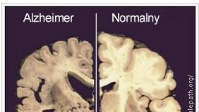 DIETA KETOGENICZNA-NOWE LECZENIE CHOROBY Alzheimera i Parkinsona