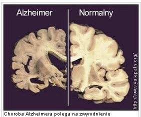 DIETA KETOGENICZNA-NOWE LECZENIE CHOROBY Alzheimera i Parkinsona