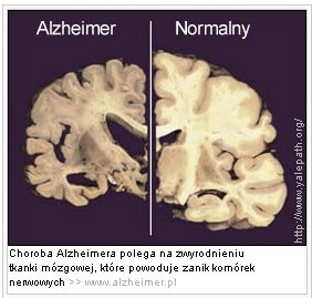 dieta w chorobie Alzheimera