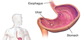 Najlepsze naturalne sposoby na zmniejszenie zgagi i wrzodów