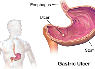 Najlepsze naturalne sposoby na zmniejszenie zgagi i wrzodów