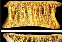 Te dwie witaminy przyjmowane razem, mogą zmniejszyć osteoporozę o 25%