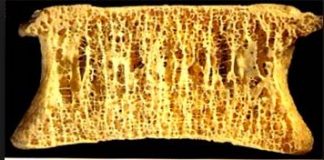 Te dwie witaminy przyjmowane razem, mogą zmniejszyć osteoporozę o 25%