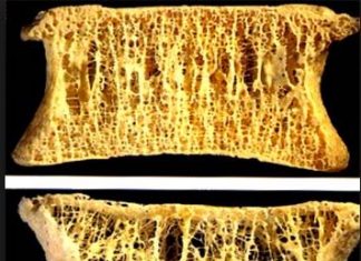 Te dwie witaminy przyjmowane razem, mogą zmniejszyć osteoporozę o 25%