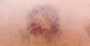 10 powodów, przez które łatwo powstają siniaki ?