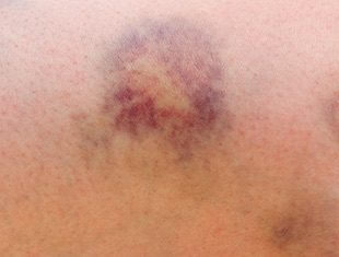 10 powodów, przez które łatwo powstają siniaki ?