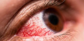 Odkryj domowe sposoby na uciążliwe infekcje oczu