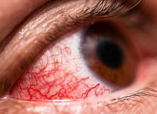Odkryj domowe sposoby na uciążliwe infekcje oczu