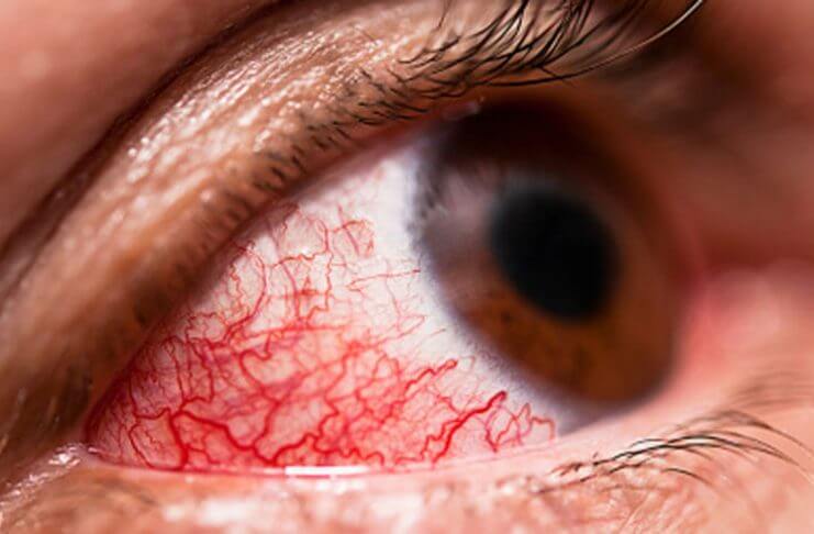 Odkryj domowe sposoby na uciążliwe infekcje oczu