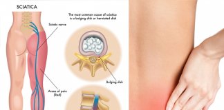 RWA KULSZOWA – NATURALNE SPOSOBY NA ZŁAGODZENIE BÓLU rwa kulszowa ból pleców