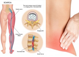 RWA KULSZOWA – NATURALNE SPOSOBY NA ZŁAGODZENIE BÓLU rwa kulszowa ból pleców