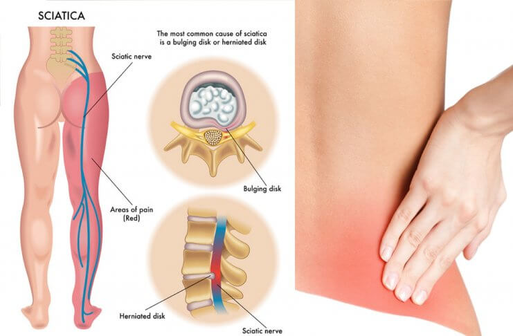 RWA KULSZOWA – NATURALNE SPOSOBY NA ZŁAGODZENIE BÓLU rwa kulszowa ból pleców