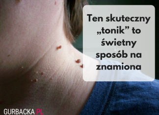 Szybki, prosty i tani sposób na znamiona