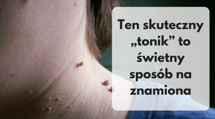 Szybki, prosty i tani sposób na znamiona