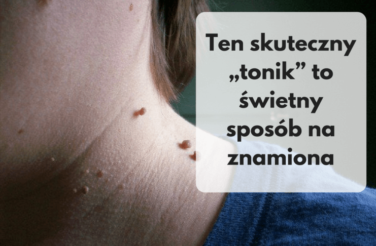 Szybki, prosty i tani sposób na znamiona