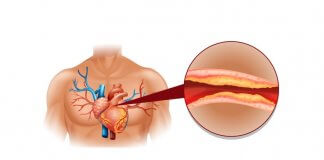 NATURALNE SPOSOBY NA OBNIŻENIE CHOLESTEROLU obniżenie cholesterolu