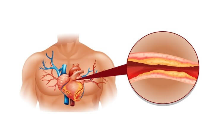 NATURALNE SPOSOBY NA OBNIŻENIE CHOLESTEROLU obniżenie cholesterolu