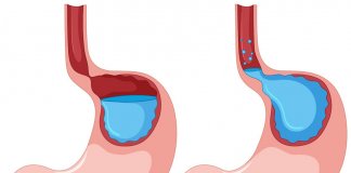 INHIBITORY POMPY PROTONOWEJ A REFLUKS – SZKODZĄ CZY LECZĄ? inhibitory pompy protonowej