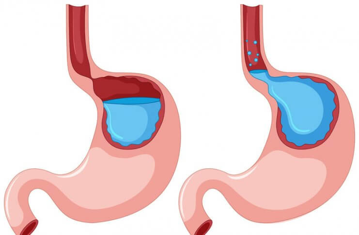 INHIBITORY POMPY PROTONOWEJ A REFLUKS – SZKODZĄ CZY LECZĄ? inhibitory pompy protonowej
