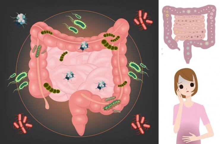 SIBO A NIEDOCZYNNOŚĆ TARCZYCY – JAK TO ZDIAGNOZOWAĆ I WYLECZYĆ? sibo niedoczynność tarczycy